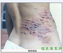 带状疱疹.jpg 带状疱疹.jpg